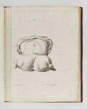 Load image into Gallery viewer, CAMPEN, Michael Johan van. Puellae monstrosae delineatio, quam annuente summo numine …